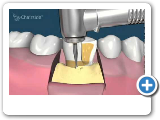 What is Crown Lengthening? - Gum Surgery - Implant & Gumcare Center Dallas TX