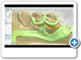 Dental System™ 2012 - Removable Partial Design