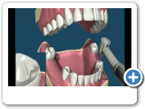 Ponciano Dental - Partial Denture.wmv