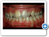 Ponciano Dental - Invisalign Cases.wmv