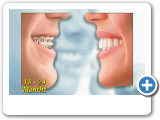 Ponciano Dental - Invisalign Advantages.wmv