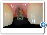 Ponciano Dental - Implant Restoration.wmv