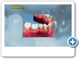 Ponciano Dental - Implant Placement.wmv