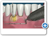 Gum Disease Treatment - Gum Surgery for Receding Gums - Implant & Gumcare Center Dallas TX