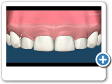 Gummy Smile Surgery - Gum Lift - Implant & Gumcare Center Dallas TX