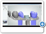 Dental System™ 2012 - Model Builder™ for implant models